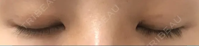 二重埋没 かわた美容クリニック DAY 27 メイン用