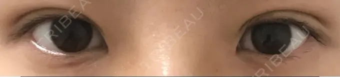 二重埋没 かわた美容クリニック DAY 27 メイン用