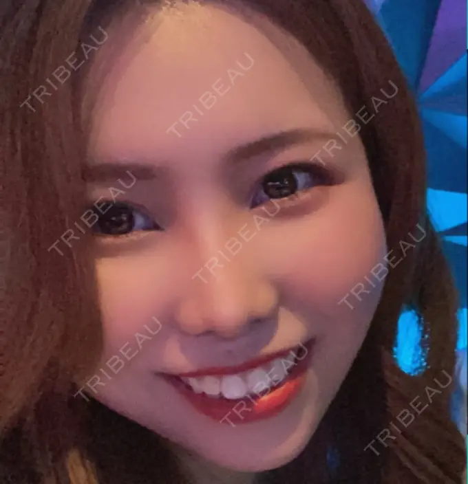 鼻尖形成（切開） / 鼻中隔延長（切開） / 軟骨移植 / 鼻孔縁下降 / その他（鼻） 湘南美容クリニック 新宿本院 DAY 183 メイン用