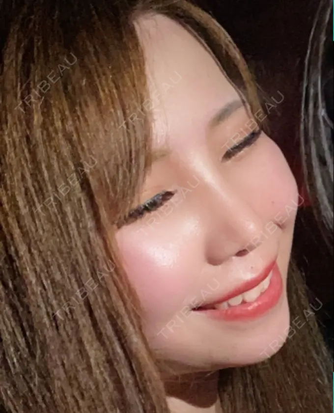 鼻尖形成（切開） / 鼻中隔延長（切開） / 軟骨移植 / 鼻孔縁下降 / その他（鼻） 湘南美容クリニック 新宿本院 DAY 183 メイン用