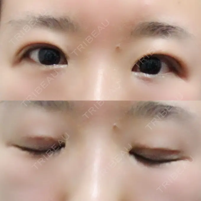 二重埋没 きくな湯田眼科 AFTER メイン用