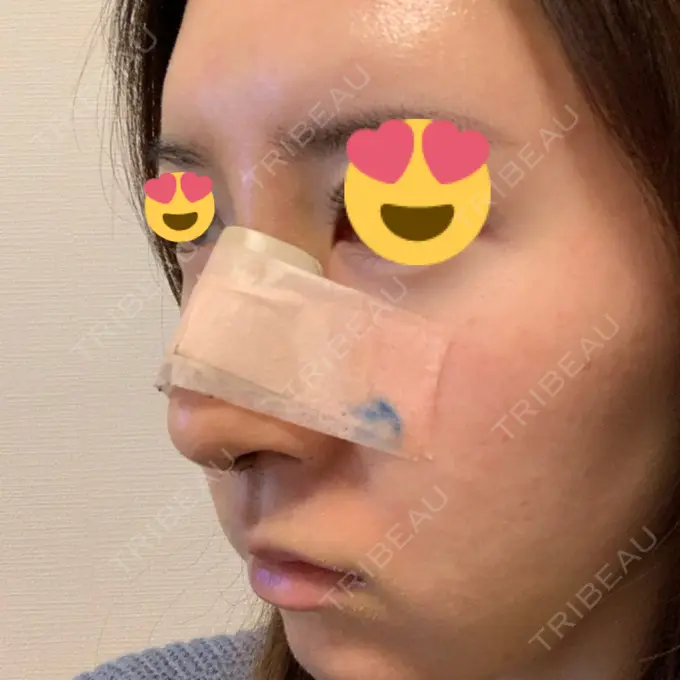 隆鼻術 / 鼻尖形成（切開） / 鼻中隔延長（切開） / 軟骨移植 / 鼻孔縁下降 Zetith Beauty Clinic 銀座院 DAY 6 メイン用