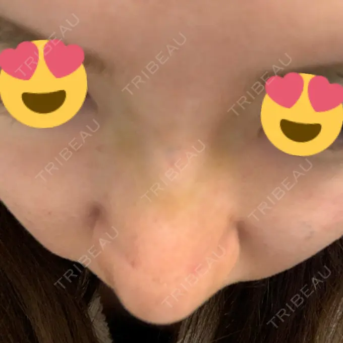 隆鼻術 / 鼻尖形成（切開） / 鼻中隔延長（切開） / 軟骨移植 / 鼻孔縁下降 Zetith Beauty Clinic 銀座院 DAY 7 メイン用