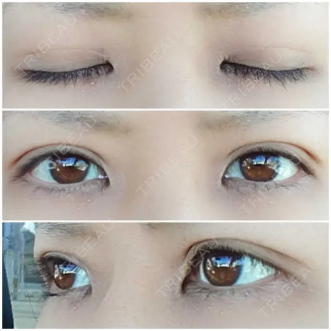 二重埋没 かわた美容クリニック DAY 28 メイン用