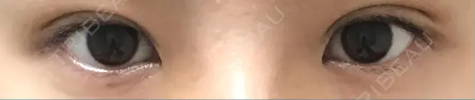 二重埋没 かわた美容クリニック DAY 29 メイン用