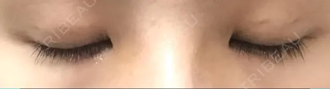 二重埋没 かわた美容クリニック DAY 29 メイン用