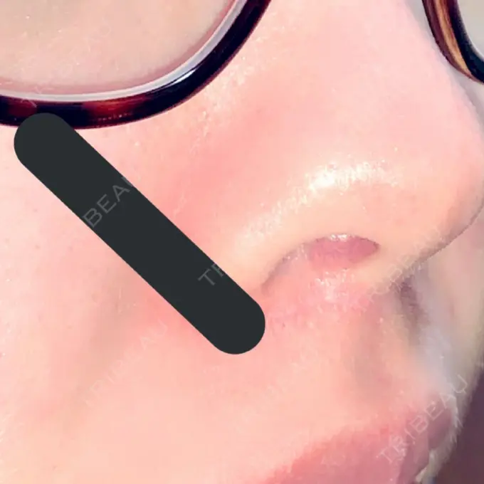 人中短縮 / PRP皮膚再生療法 BIANCA銀座 DAY 160 メイン用