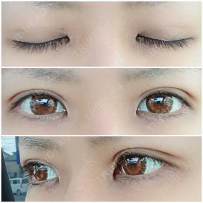 二重埋没 かわた美容クリニック DAY 29 メイン用