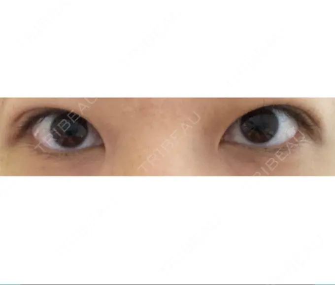 二重埋没 共立美容外科 大宮院 DAY 30 メイン用