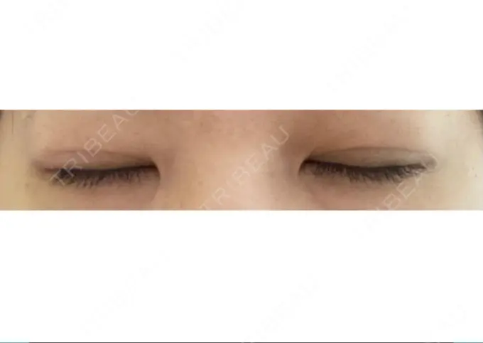 二重埋没 共立美容外科 大宮院 DAY 30 メイン用