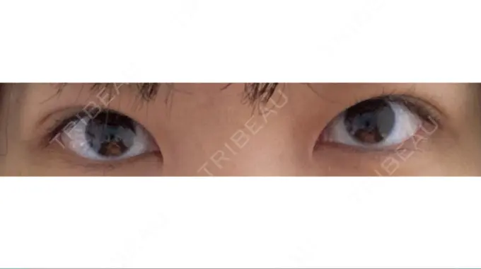 二重埋没 共立美容外科 大宮院 DAY 31 メイン用