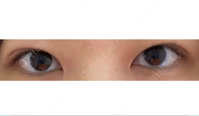 二重埋没 共立美容外科 大宮院 DAY 32 メイン用