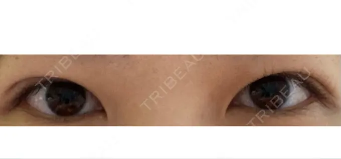 二重埋没 共立美容外科 大宮院 DAY 33 メイン用