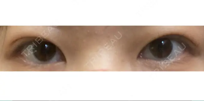 二重埋没 共立美容外科 大宮院 DAY 40 メイン用