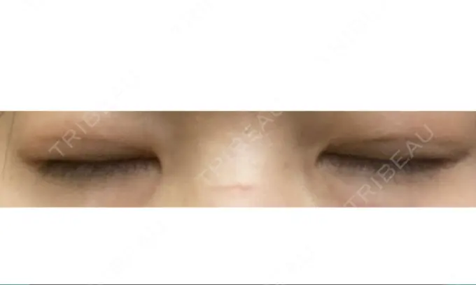 二重埋没 共立美容外科 大宮院 DAY 40 メイン用