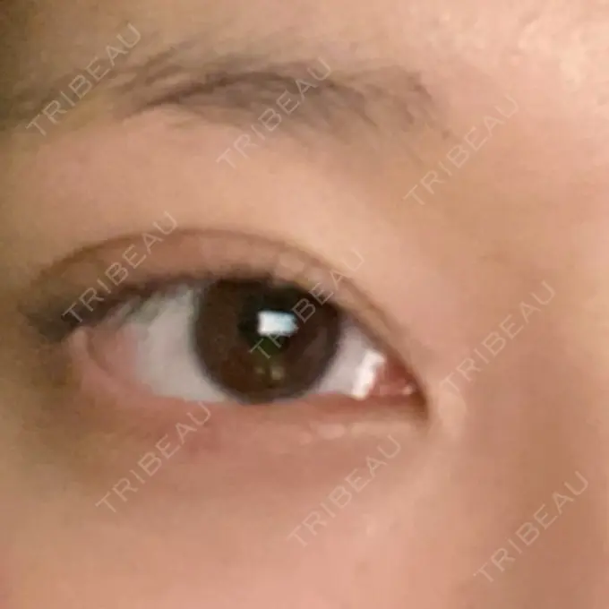 二重埋没 R Beauty CLINIC 銀座院 DAY 3 メイン用