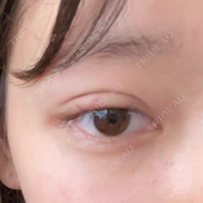 二重埋没 R Beauty CLINIC 銀座院 DAY 3 メイン用