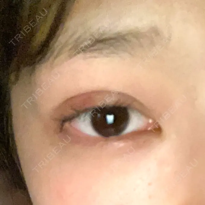 二重埋没 R Beauty CLINIC 銀座院 DAY 3 メイン用