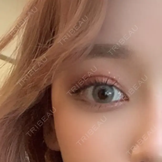 二重埋没 R Beauty CLINIC 銀座院 DAY 7 メイン用