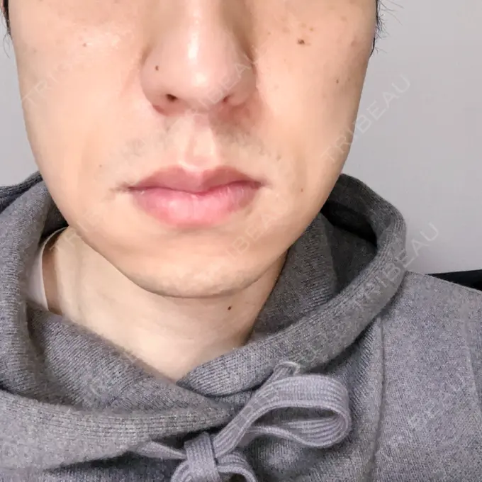 骨切り（あご） / 骨削り（エラ） 心斎橋コムロ美容外科クリニック DAY 35 メイン用