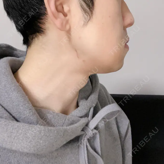 骨切り（あご） / 骨削り（エラ） 心斎橋コムロ美容外科クリニック DAY 35 メイン用