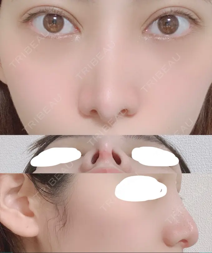 鼻尖形成（切開） / 鼻中隔延長（切開） / 骨切幅寄せ / 鼻修正 湘南美容クリニック 新橋銀座口院 DAY 36 メイン用