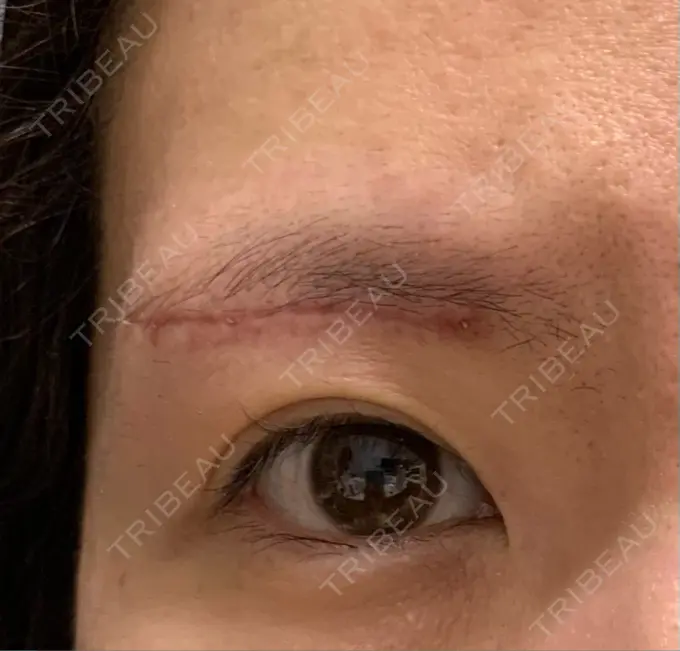 眉下切開 城本クリニック 福岡院 DAY 28 メイン用