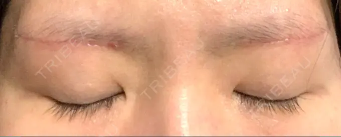 眉下切開 城本クリニック 福岡院 DAY 28 メイン用