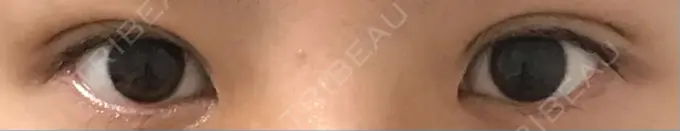 二重埋没 かわた美容クリニック DAY 31 メイン用