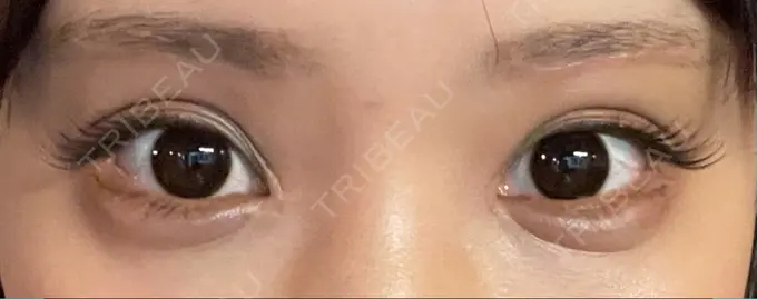 眉下切開 湘南美容クリニック 高田馬場院 DAY 29 メイン用