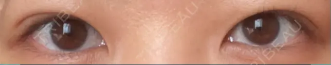 二重埋没 共立美容外科 大宮院 DAY 44 メイン用