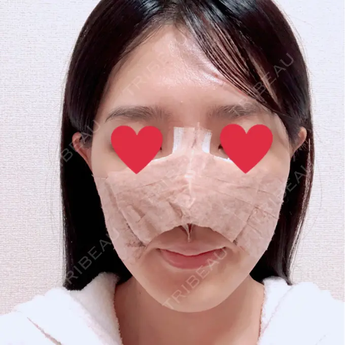 鼻中隔延長（切開） みずほクリニック DAY 2 メイン用