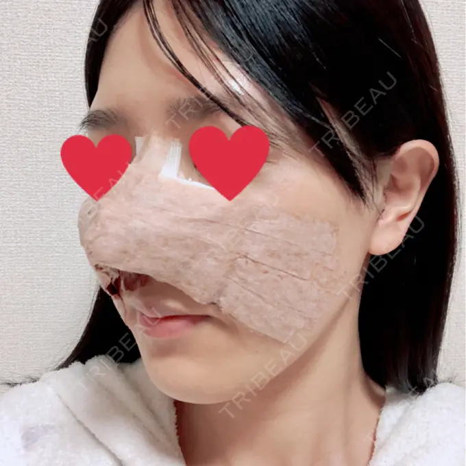 鼻中隔延長（切開） みずほクリニック DAY 2 メイン用