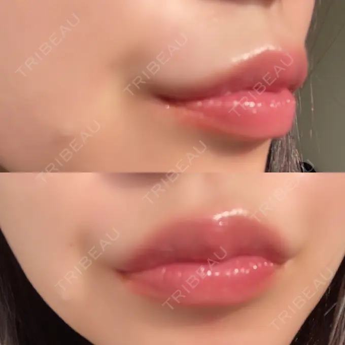 人中短縮 / ヒアルロン酸注入（唇） / ボトックス（口角） ルラ美容クリニック 高田馬場院 DAY 40 メイン用