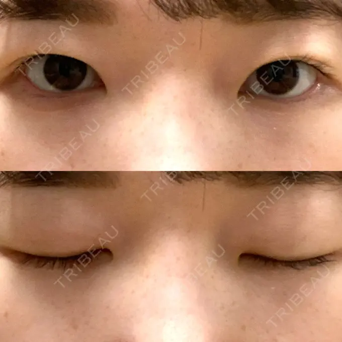 二重埋没 湘南美容クリニック 東京蒲田院 AFTER メイン用