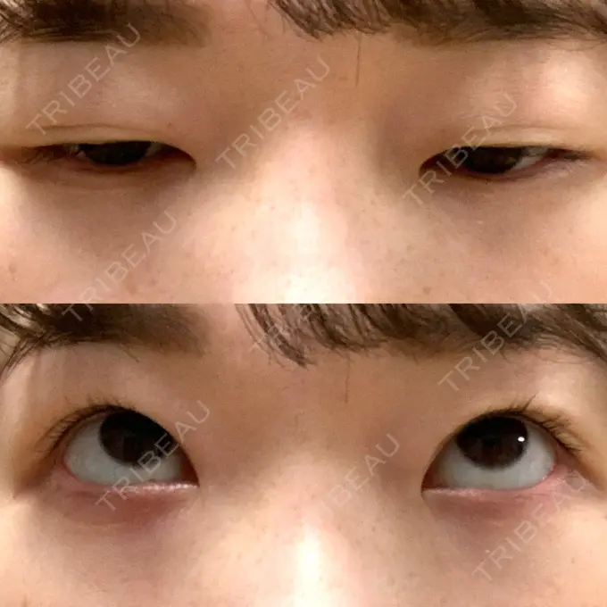 二重埋没 湘南美容クリニック 東京蒲田院 DAY 361 メイン用