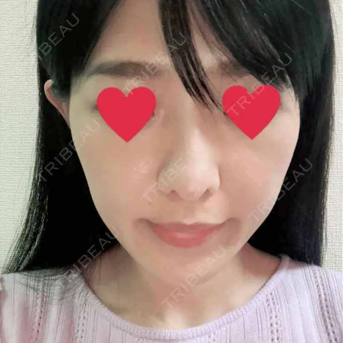 鼻中隔延長（切開） みずほクリニック DAY 8 メイン用