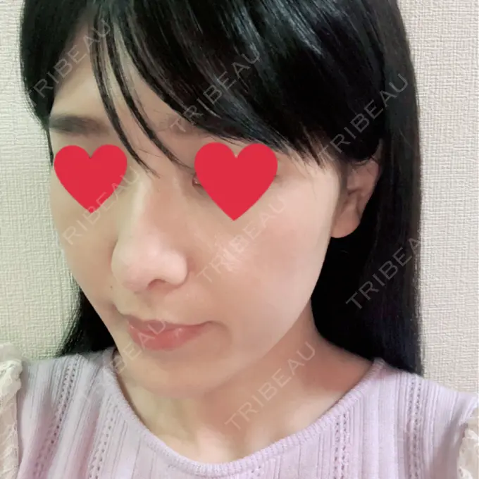 鼻中隔延長（切開） みずほクリニック DAY 8 メイン用