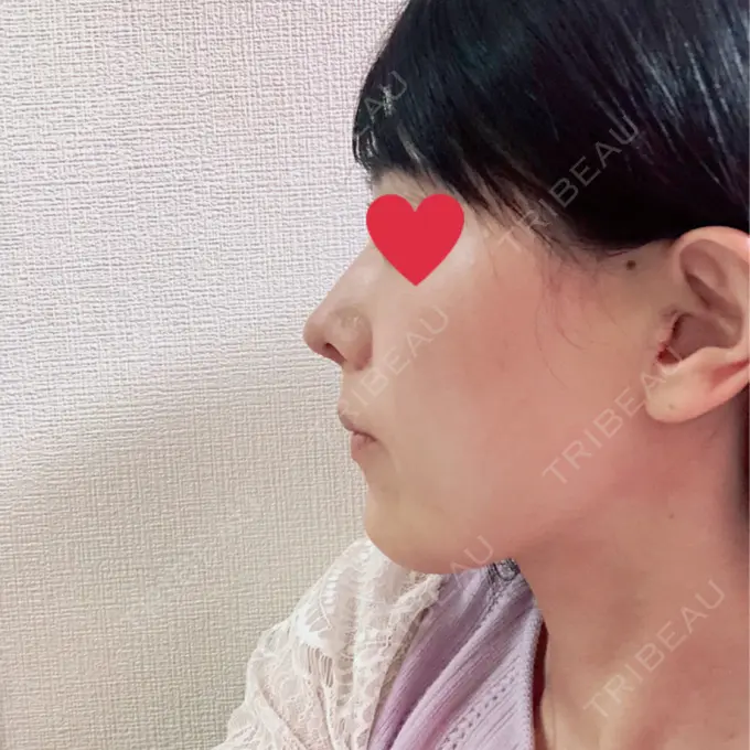 鼻中隔延長（切開） みずほクリニック DAY 8 メイン用