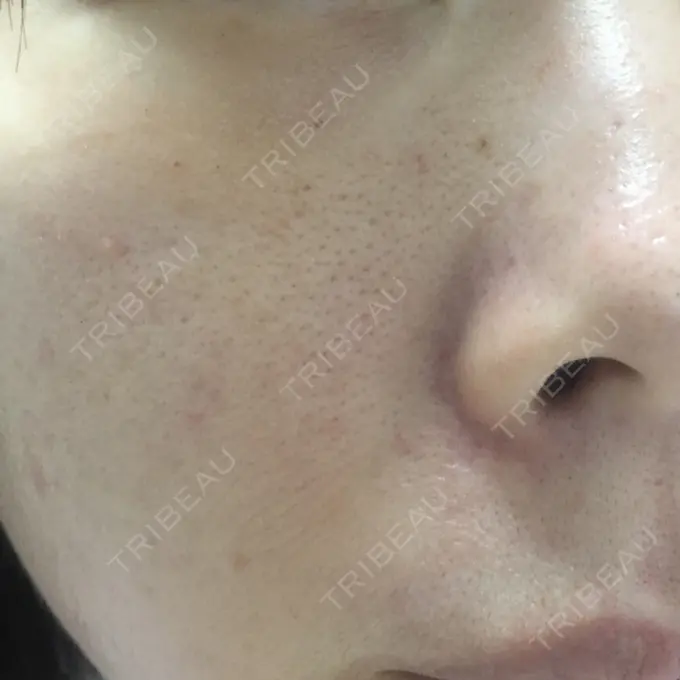 毛穴洗浄（ハイドラフェイシャルなど） / ピコレーザートーニング（美白・肝斑） / フラクショナルレーザー（毛穴・ニキビ跡） B-LINE CLINIC 池袋院 DAY 27 メイン用