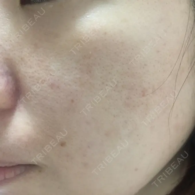 毛穴洗浄（ハイドラフェイシャルなど） / ピコレーザートーニング（美白・肝斑） / フラクショナルレーザー（毛穴・ニキビ跡） B-LINE CLINIC 池袋院 AFTER メイン用