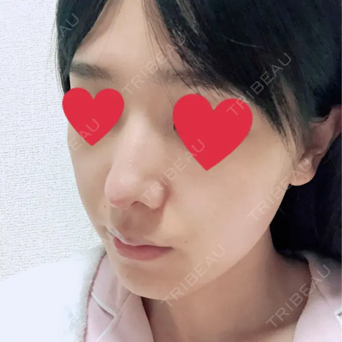 鼻中隔延長（切開） みずほクリニック DAY 9 メイン用