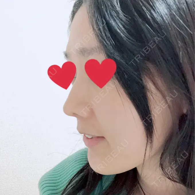 鼻中隔延長（切開） みずほクリニック DAY 35 メイン用