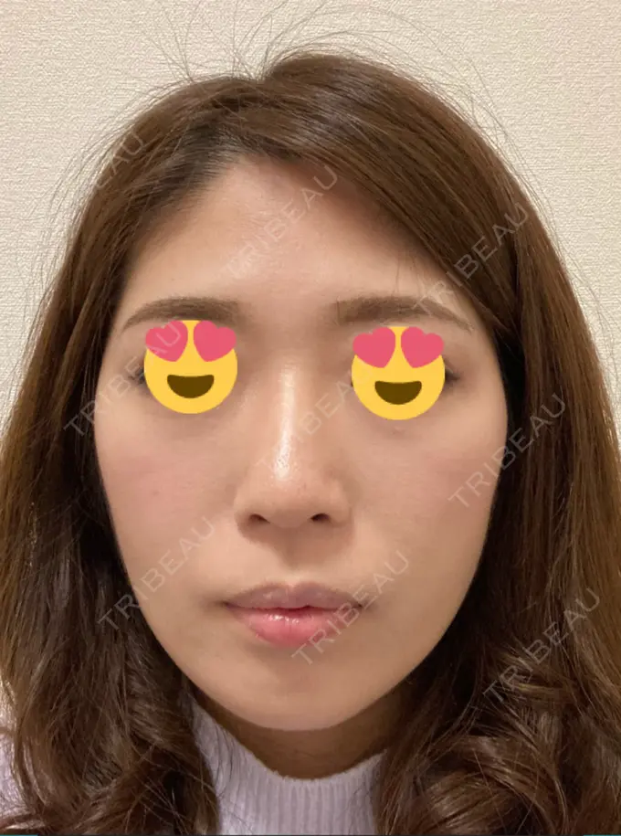 脂肪吸引（顔） ジョウクリニック 大阪院 DAY 50 メイン用