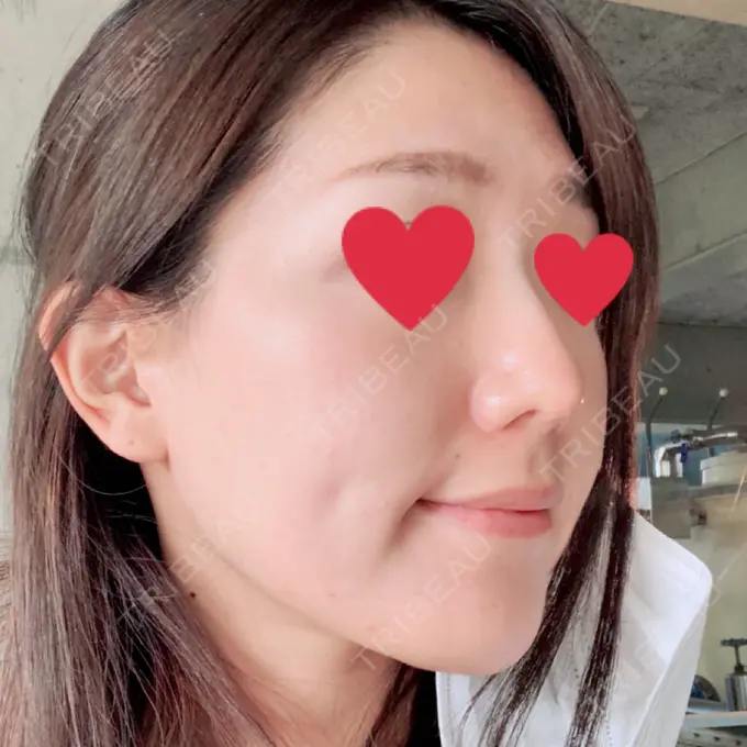 鼻中隔延長（切開） みずほクリニック AFTER メイン用