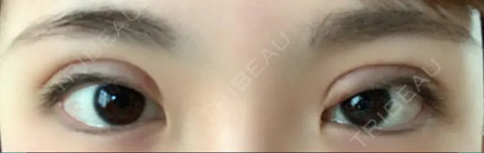 二重切開 / 上まぶたの脂肪取り / その他（目元） CLASSY 仙台美容外科・美容皮膚科 DAY 9 メイン用