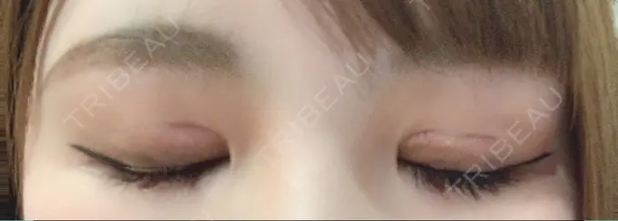 二重切開 / 上まぶたの脂肪取り / その他（目元） CLASSY 仙台美容外科・美容皮膚科 DAY 10 メイン用