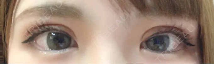 二重切開 / 上まぶたの脂肪取り / その他（目元） CLASSY 仙台美容外科・美容皮膚科 DAY 10 メイン用