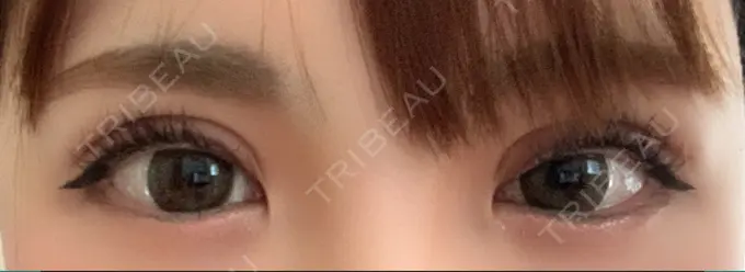 二重切開 / 上まぶたの脂肪取り / その他（目元） CLASSY 仙台美容外科・美容皮膚科 DAY 11 メイン用