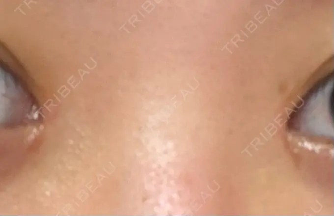 二重埋没 / 目頭切開 ドクター松井クリニック 新宿 DAY 48 メイン用